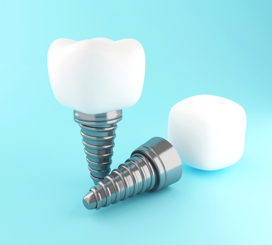 Implantes dentales Torremolinos - clínica dental Neptuno